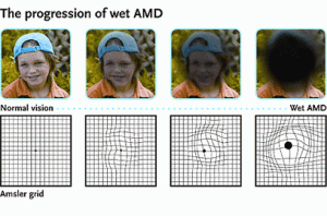 Progression of wet macular degeneration