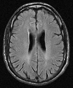 MRI Huntington's Disease