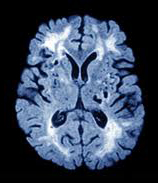 MRI-vascular-dementia-diffuse-white-matter