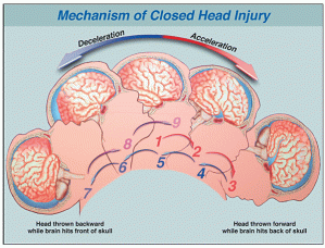 Closed Head Injury Traumatic Brain Injury