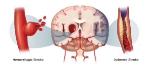 Stroke risks rise for everyone in the 48 hours after DST begins