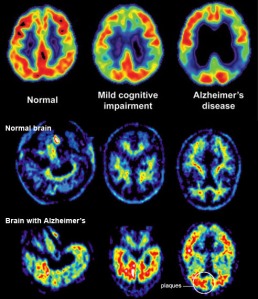 Pre-Diabetes & Type 2 Diabetes Cause the Plaques and Tangles of Alzheimer's Disease, Leading to Brain Shrinkage as the Diseases Progress